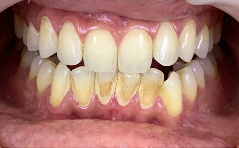 Teeth Whitening Treatment in HSR Layout and Koramangala