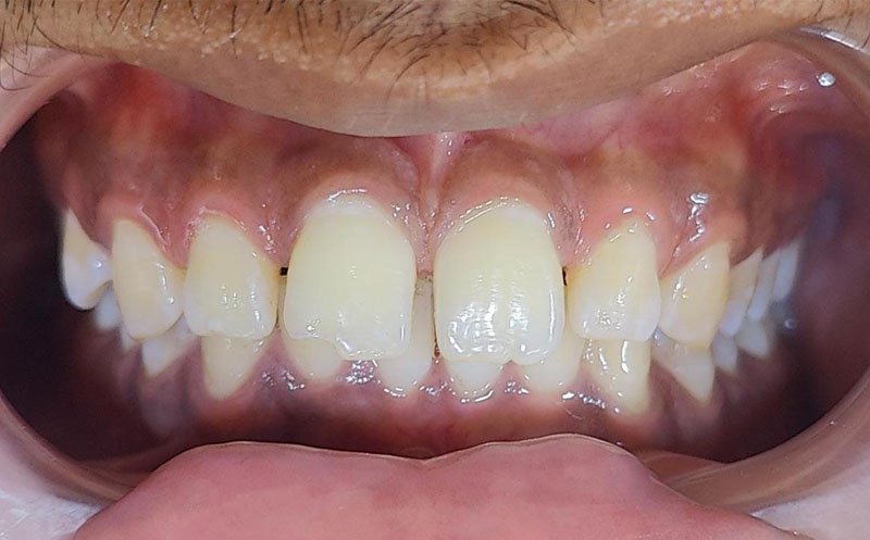 Braces and Aligners in HSR Layout and Koramangala
